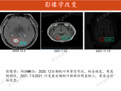 细胞免疫疗法,细胞免疫治疗肺癌的案例分析