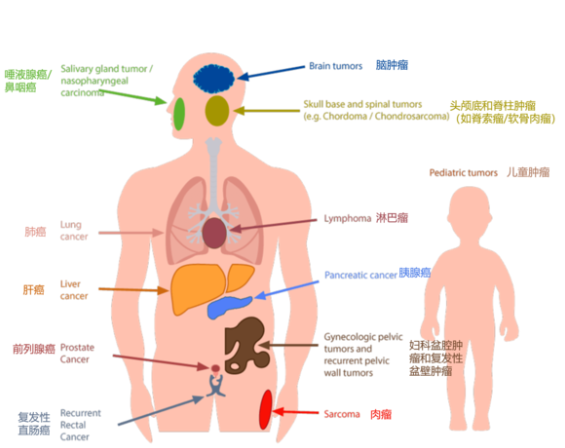 质子重离子可以治疗的癌症肿瘤