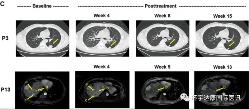 GPC3 CAR-T治疗肝癌的效果