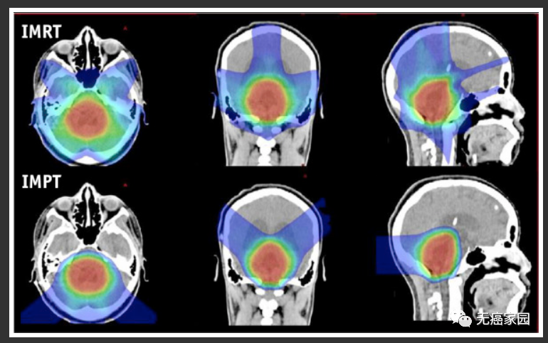 质子治疗颅窝室管膜瘤