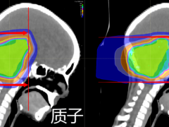 什么是放疗,放射治疗是什么意思,放射治疗分类,放射治疗的种类有哪些