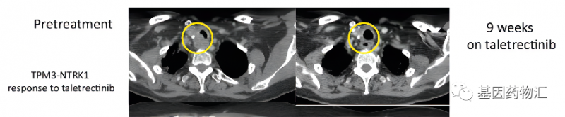 Taletrectinib治疗甲状腺癌的效果