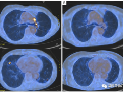 EGFR基因突变的肺腺癌抗癌成功案例