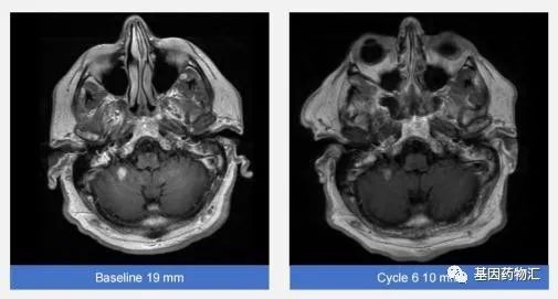 CLN-081治疗脑转移的效果