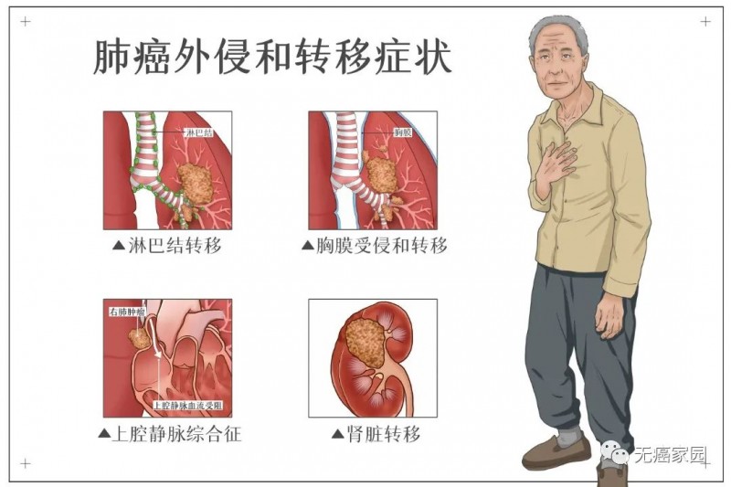 肺癌外侵和转移的症状