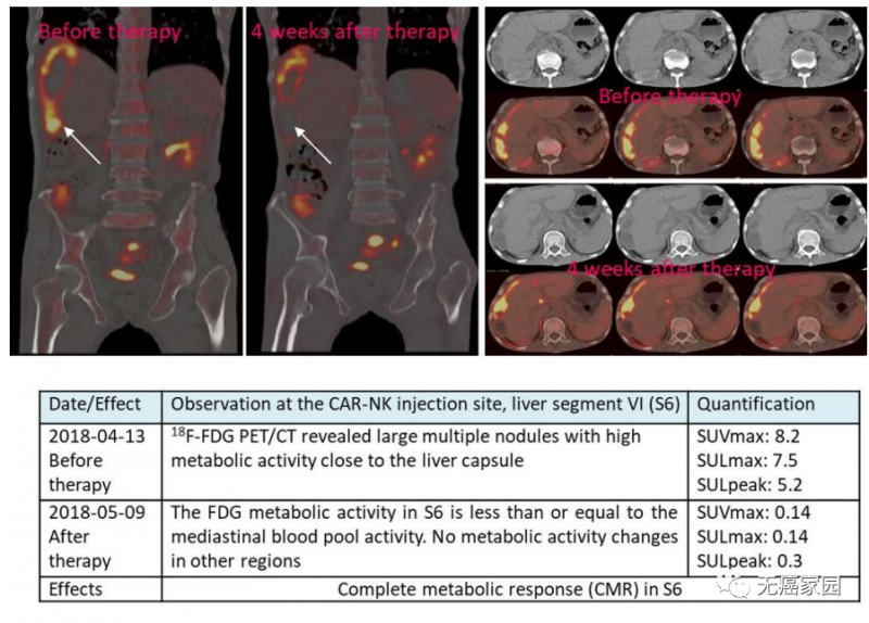 CAR-NK 细胞治疗后肝转移病灶 PEC-CT 结果对比图