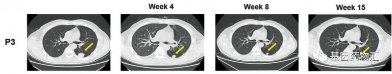 CAR-GPC3 T细胞疗法治疗肝癌的效果