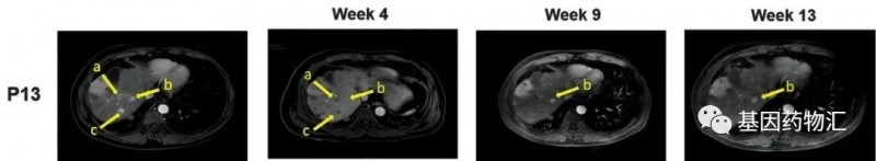 CAR-GPC3-T细胞疗法治疗肝癌的效果