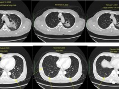 肺腺癌怎么治疗,看看这位肺里有超过100个肺癌病灶的患者可能用到的治疗方式
