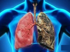 NK细胞疗法治疗肺癌的新研究