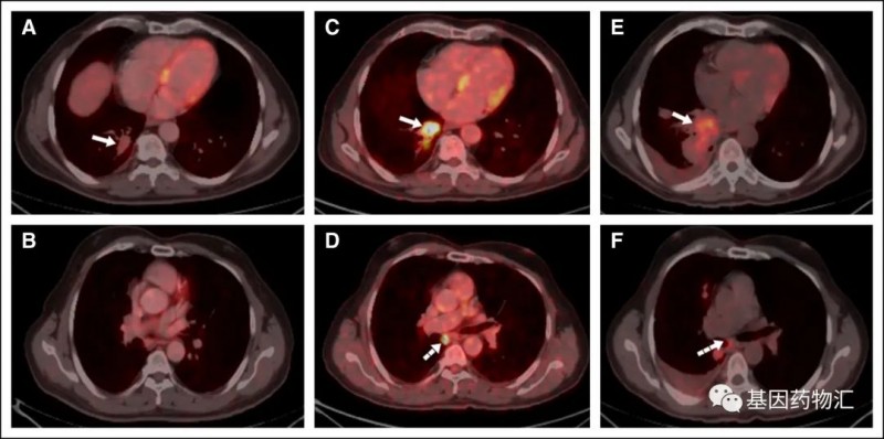 非小细胞肺癌EGFR治疗效果