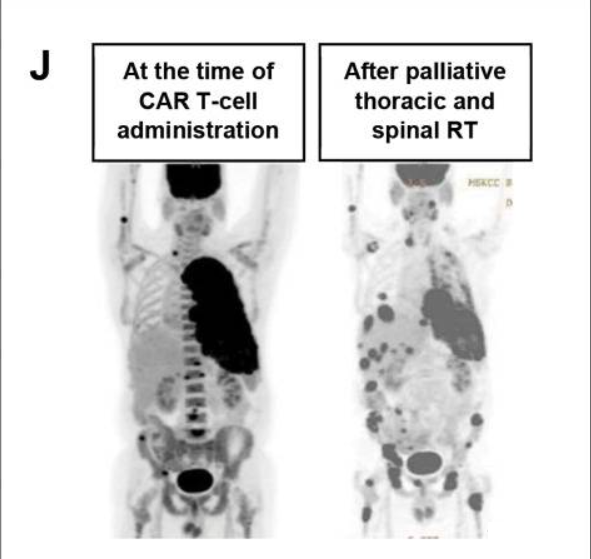 CART联合PD1治疗上皮样间皮瘤的效果