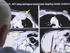 没有基因突变又拒绝化疗!新型细胞免疫疗法让70岁晚期肺癌大婶完全缓解超4年
