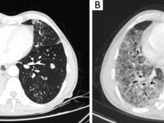 晚期肺癌抗癌成功案例,EGFR罕见突变的患者用国产第三代EGFR抑制剂甲磺酸伏美替尼(艾弗沙、AST2818)治疗已经成功抗癌3年