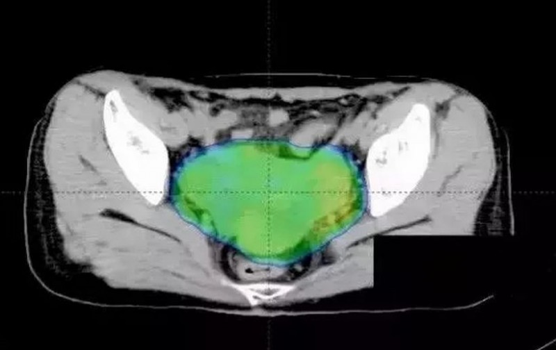 卵巢癌质子治疗后CT影像图