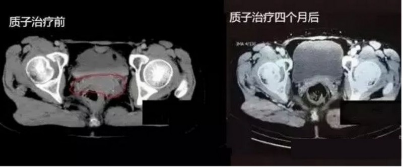 卵巢癌质子治疗前后对比