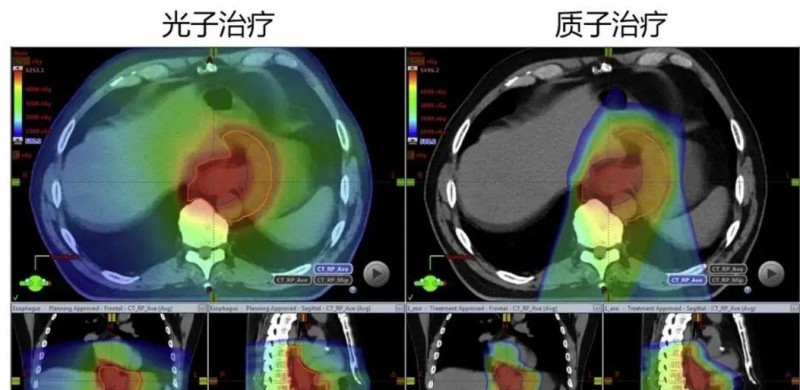 食管癌质子治疗和光子治疗对比