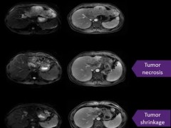 肝癌新疗法,特异性TCR-T疗法LioCyx-M临床试验招募肝癌患者正在进行中