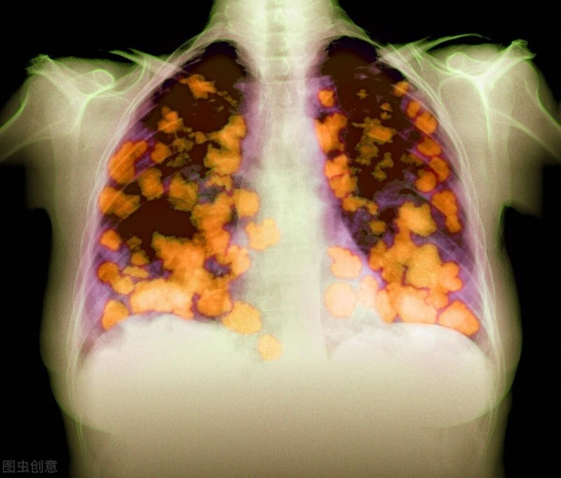 硼中子治疗肺癌的效果
