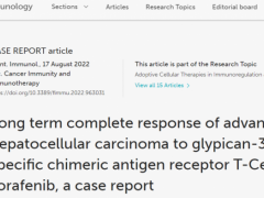国产靶向GPC3的CAR-T细胞疗法联合索拉菲尼治疗晚期肝癌首例完全缓解案例公布,肿瘤全部消失超过两年