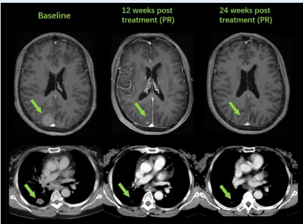 AB-106治疗肺癌脑转移的效果