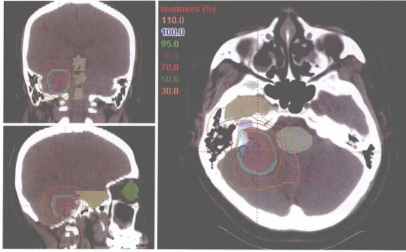 质子治疗听神经瘤