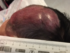 对25种癌症有效的广谱抗癌药拉罗替尼治疗两个周期病灶完全消失