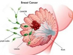 乳腺癌术后放疗方案记住这六点很关键