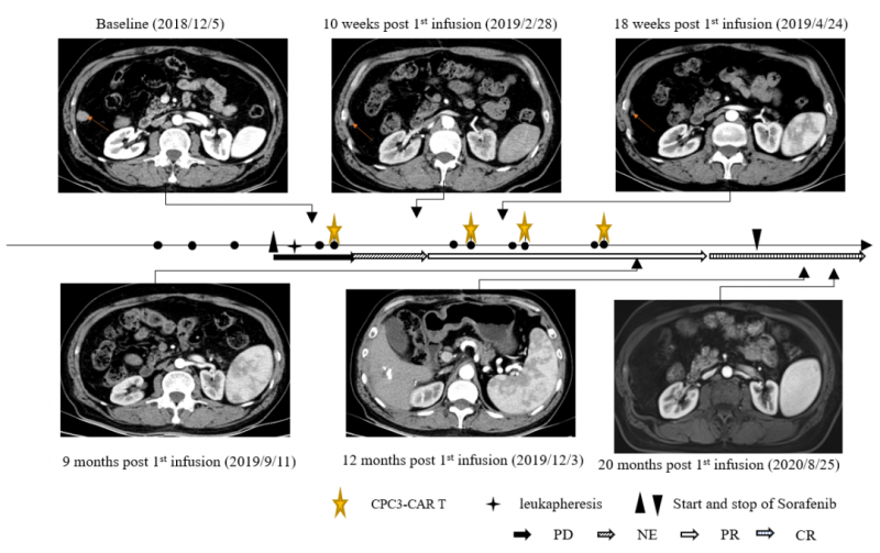 GPC3CART疗法治疗晚期肝癌的效果
