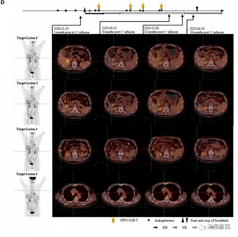 GPC3CART疗法治疗晚期肝癌后的PET-CT影像图