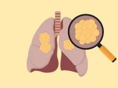 肺癌靶向治疗的副作用有哪些,八大肺癌靶向药物副作用和肺癌靶向药副作用处理方法都在这里了