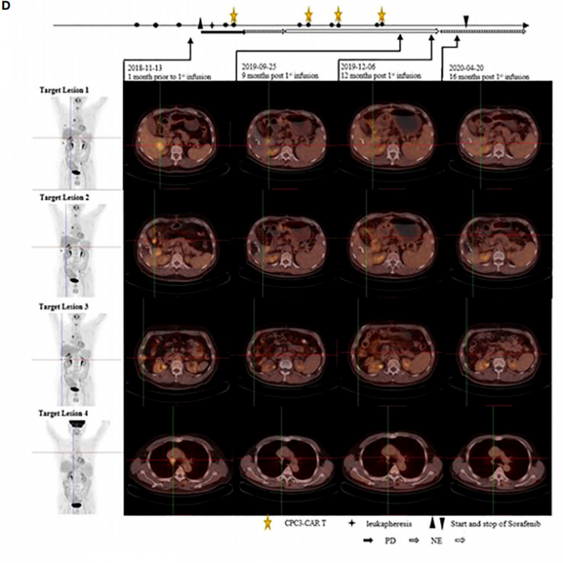 GPC3 CAR-T细胞疗法治疗肝癌的CT效果