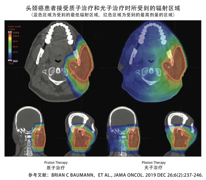 头颈部肿瘤质子治疗