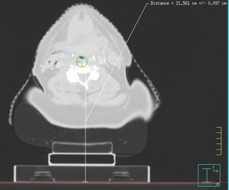 头颈部肿瘤放疗模拟定位