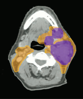 头颈部肿瘤放疗靶区规划