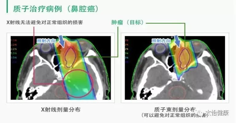 质子治疗鼻腔癌