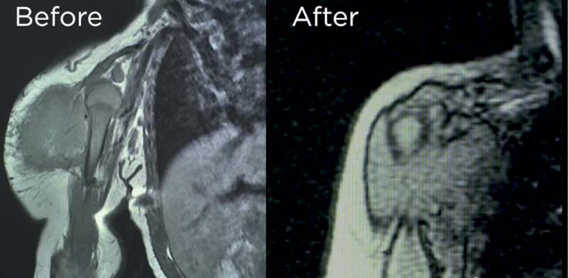 拉罗替尼治疗婴儿纤维肉瘤后的影像图