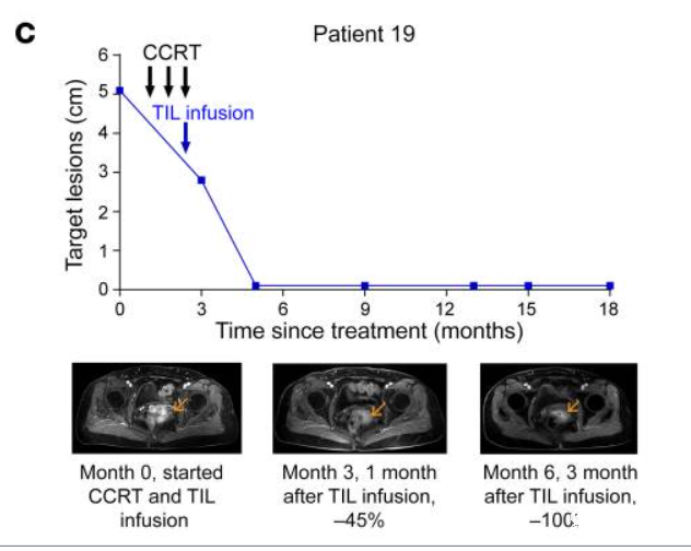 TIL细胞疗法治疗成功案例