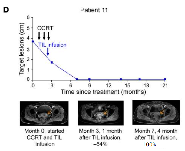 TIL细胞疗法治疗成功案例