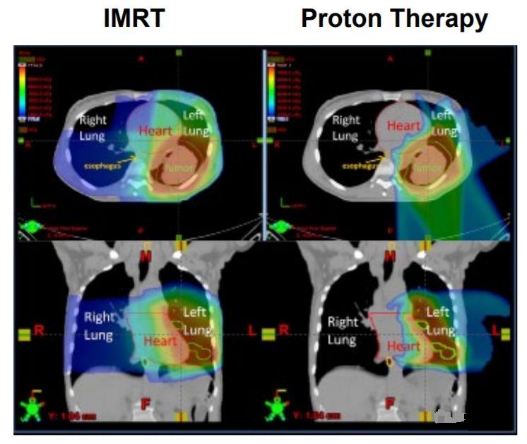 肺癌质子治疗和传统放疗对比