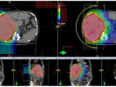 质子治疗胃癌、肝癌、食管癌、等腹腔癌疗效优势明显