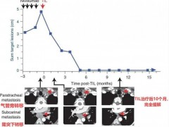 肿瘤浸润淋巴细胞(TILs)疗法治疗各类晚期癌症患者"奇迹"缓解,用自体免疫细胞治疗癌症肿瘤将成为现实