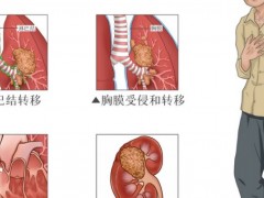 肺癌延长生命和预防复发的方法有哪些