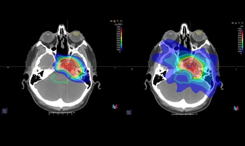 肺癌脑转移质子治疗和传统放疗对比