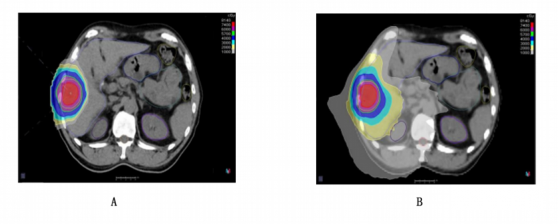质子治疗和传统放疗治疗肝癌对比