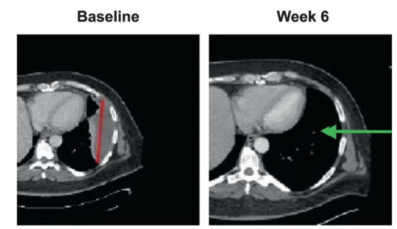 afami-cel治疗滑膜肉瘤胸膜转移的效果