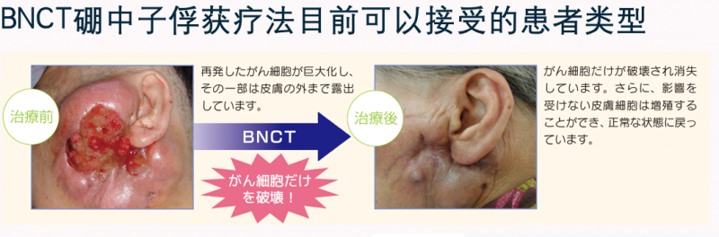 BNCT硼中子疗法治疗头颈部肿瘤的效果