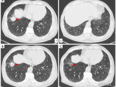 肺鳞癌有靶向药吗,来看看这几个肺鳞癌临床试验招募信息吧