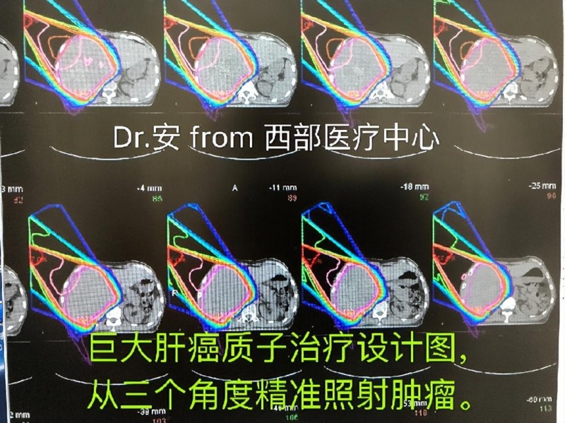 巨大肝癌质子治疗设计图