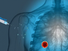 预防复发、延长生存期,古巴肺癌疫苗Cimavax-EGF新数据公布